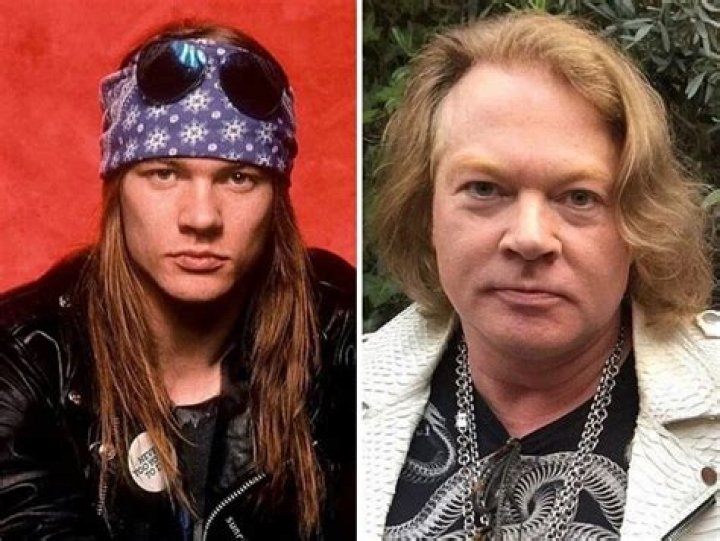 Axl Rose Plastic Surgery: The Evolution Of A Rock Icon