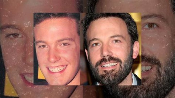 Ben Affleck’s Teeth Before And After: Secret Reveled!