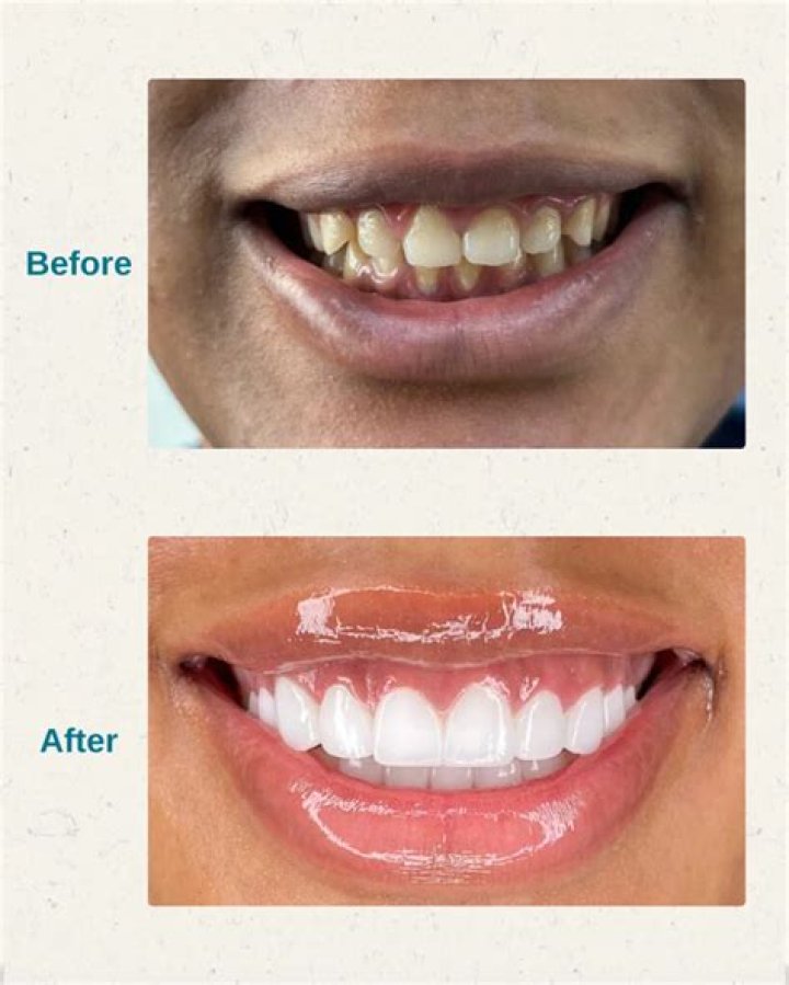Clear braces company SmileDirectClub aims to give clients a Hollywood smile without going to the dentist – The Sun