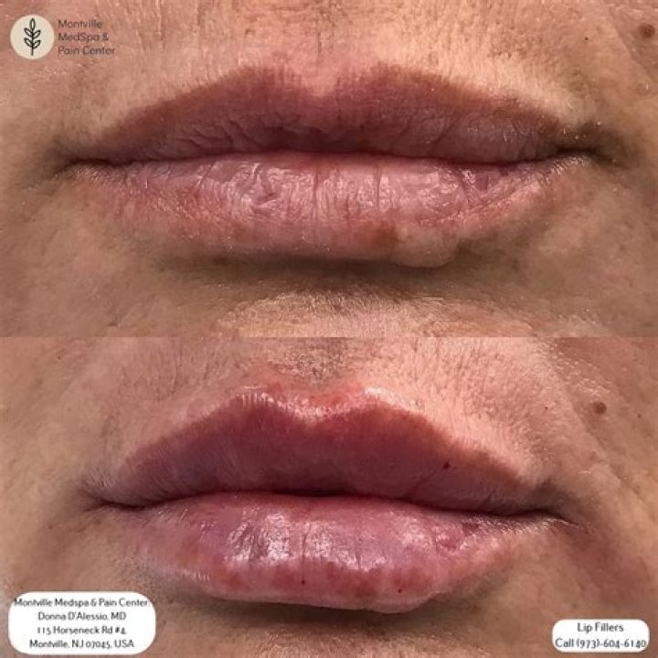 Deavan Clegg reveals botched lip fillers, credits Larissa Lima and her PA for helping her
