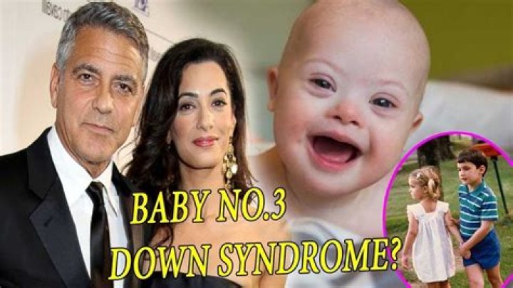 Does George Clooney's Son Have Down Syndrome?