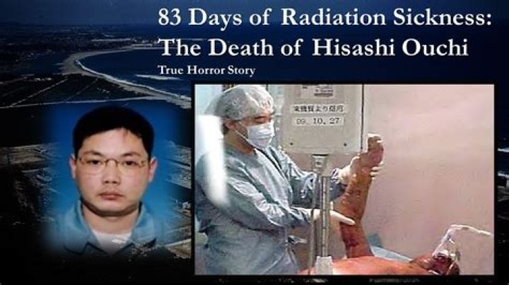 Exploring The Real Image Of Hisashi Ouchi: A Tragic Tale Of Radiation Exposure