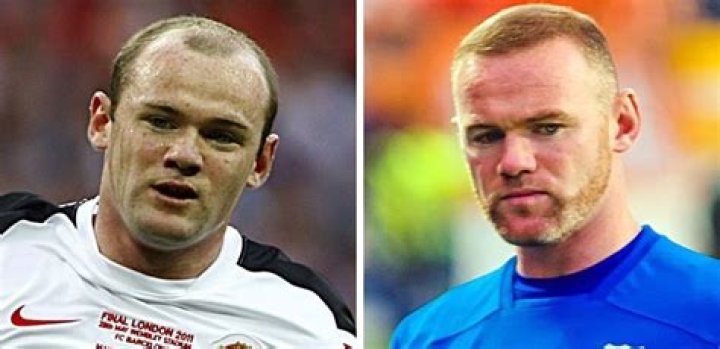 Footballers pay up to £30,000 and left unrecognisable after hair transplants including Man Utd legend Wayne Rooney – The Sun