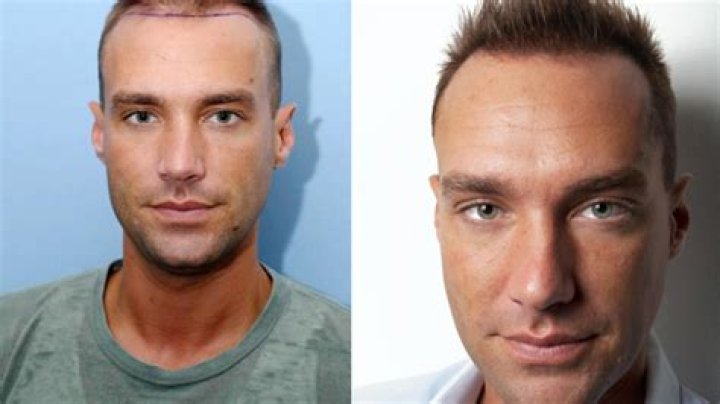How do hair transplants work and which celebrities have had the procedure? From Brian McFadden to George Sampson