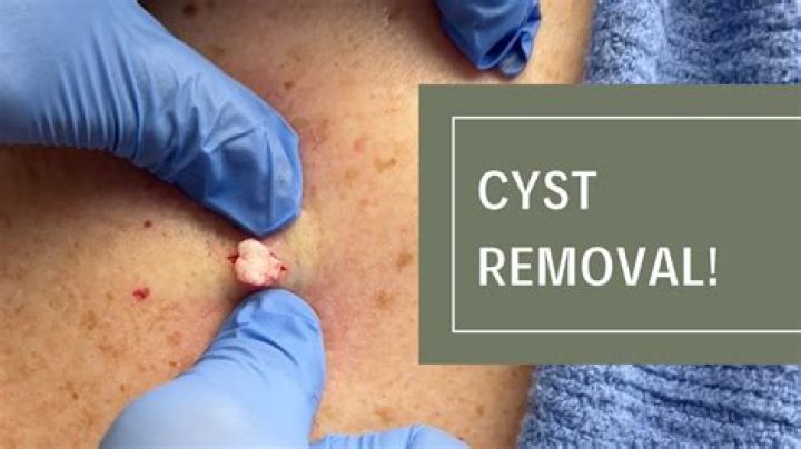 How to Remove a Cyst on Your Back