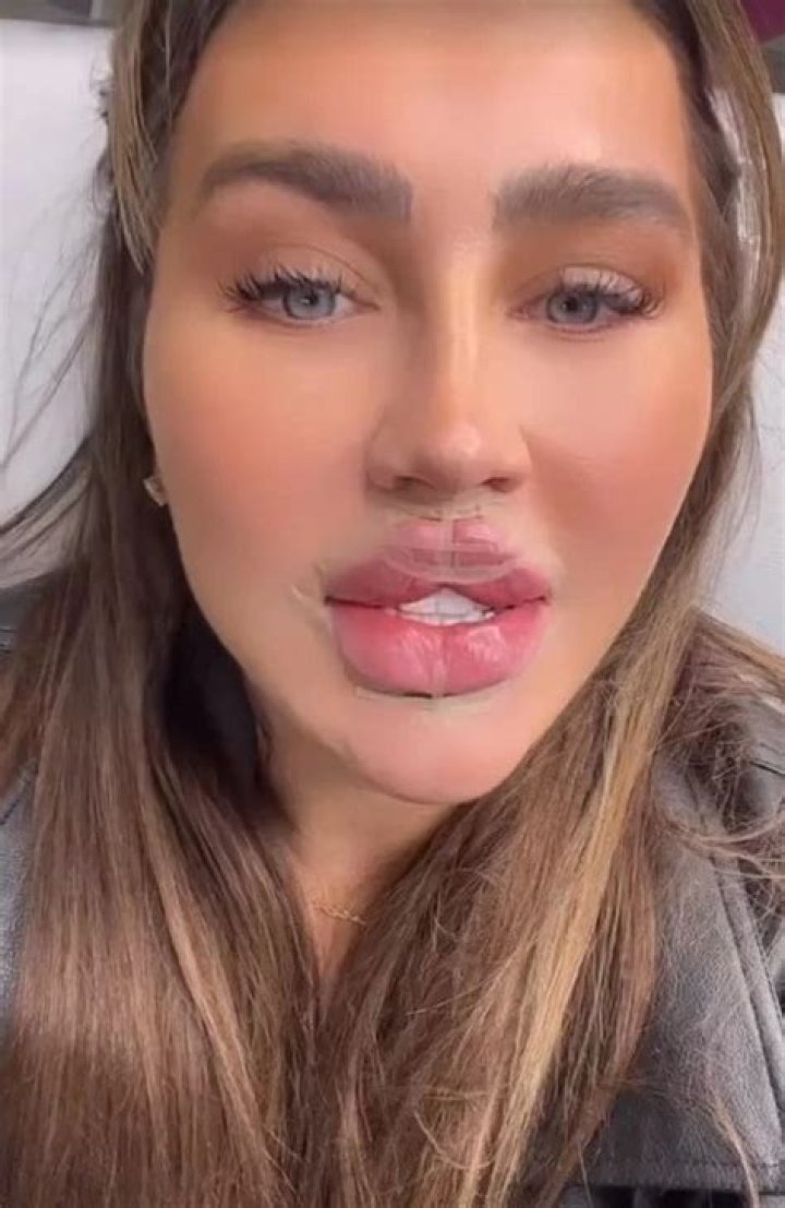 I’m an aesthetics doctor - here’s my verdict on the butterfly lips trend as seen on Katie Price and Lauren Goodger