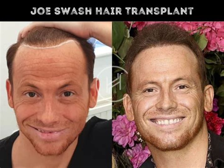 Joe Swash reveals he's had a THIRD hair transplant and girlfriend Stacey Solomon is 'totally supportive'