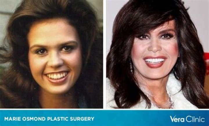 Marie Osmond’s Plastic Surgery Transformation: Before and After Photos