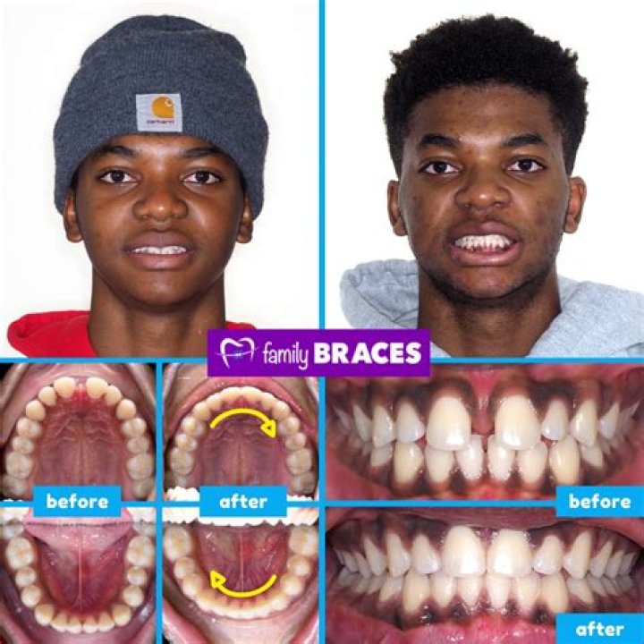 Mark Selby Teeth Before And After: Has He Whitened Them And Used Braces?