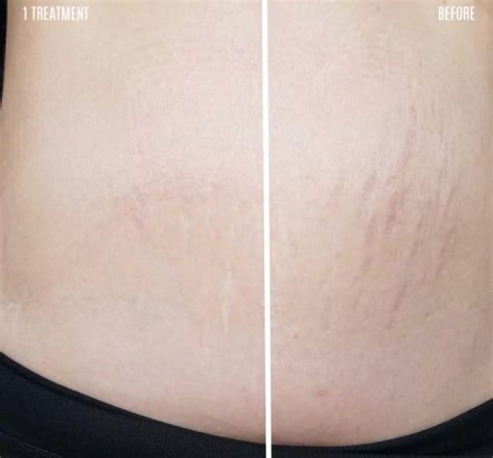 Mum who rubs breast milk on ‘tiger stripe’ stretch marks 'can't believe the difference' after scars dramatically fade