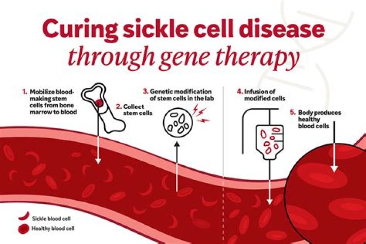 New Sickle Cell Treatments Could Be Promising