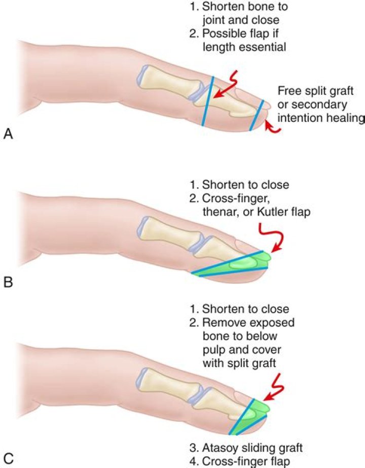 PAD can result in unnecessary limb amputations if left untreated