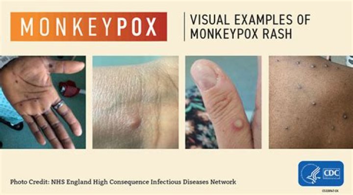 Possible monkeypox case reported in New York City, health department says