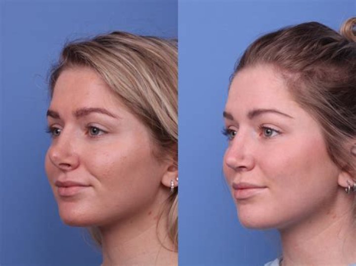 Trey Gowdy Nose Plastic Surgery Before & After Photos