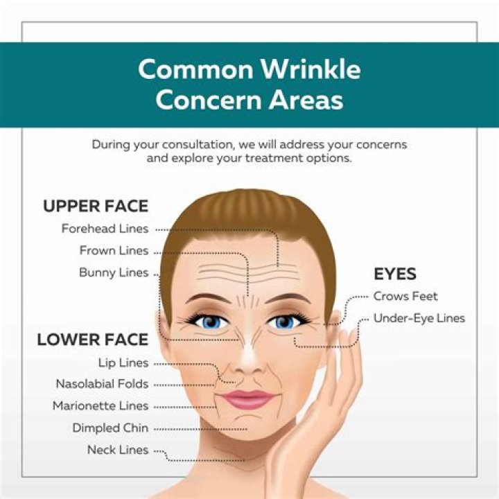 What are face wrinkles called