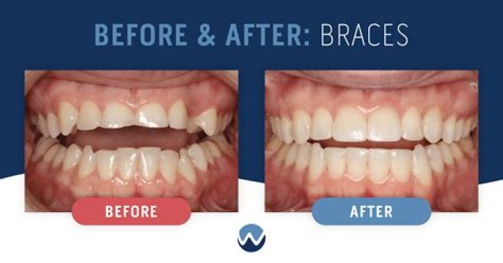 What Happened To Joe Joyce Teeth: Has He Whitened Them And Used Braces?